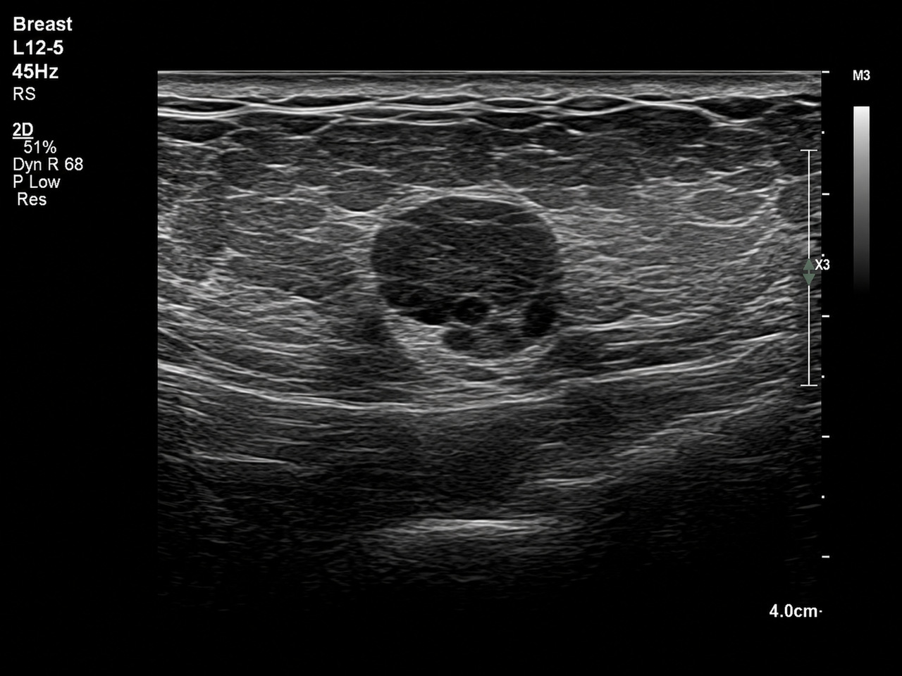 Breast Ultrasound At AG Lifecare Clinic