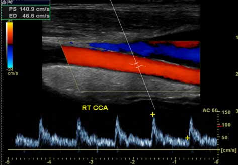 carotid ultrasound imaging At AG Lifecare Clinic